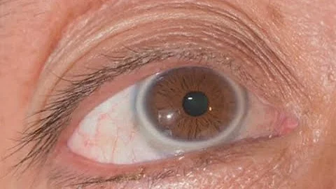 ¿Por qué los ojos de los ancianos se vuelven azules?