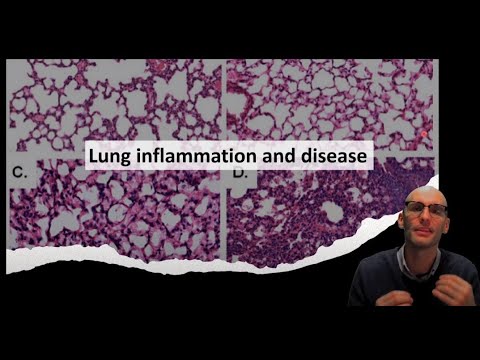 Lung inflammation and disease