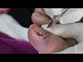 Ep_2504 Big ingrown toenail removal 👣 ดูเหมือนเล็ก..แต่ออกมาซิ 😷  (This clip is from Thailand)