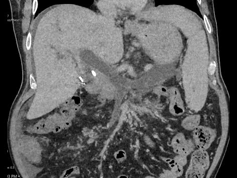 Portal - splenic