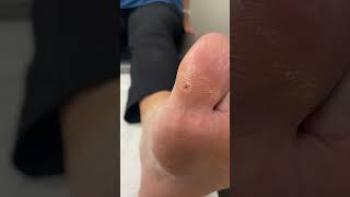 Delving Into Podiatry Down Under! Watch How This Australian Expert Tackles Big Toe Callus. #Footheal