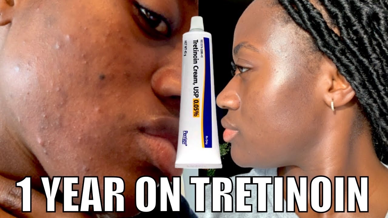 Я использовала третиноин в течение года 😱 Результаты и обновления Retin-A