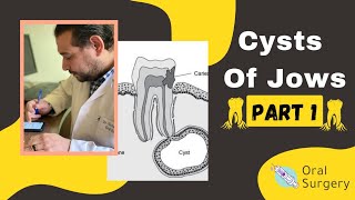 Cysts of Jows, Oral ( Part #1 ) | د. محمد عادل