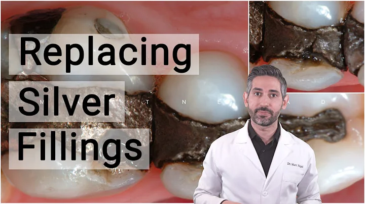 Replacing Silver Fillings: A Natural Alternative