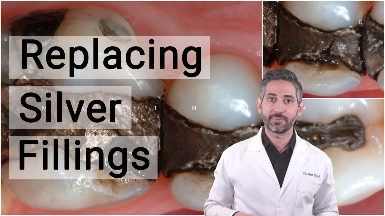 Do White Fillings Turn Black?