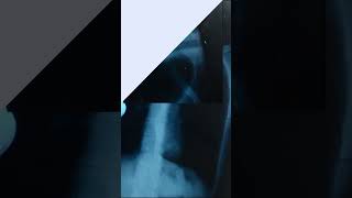 Common Symptoms Of Lung Disease You Should Never Ignore | Stem Cell For Lung Disease | Stem Cell
