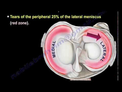 meniscus tear, knee injury,lateral meniscus Everything You Need To Know Dr. Nabil Ebraheim