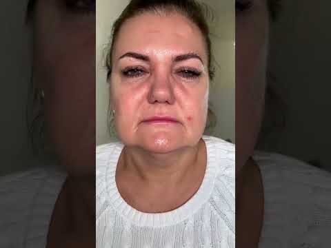 النتيجة النهائية حلوه  اكسبلور جمال دبي بوتكس شفايف شد الترهلات