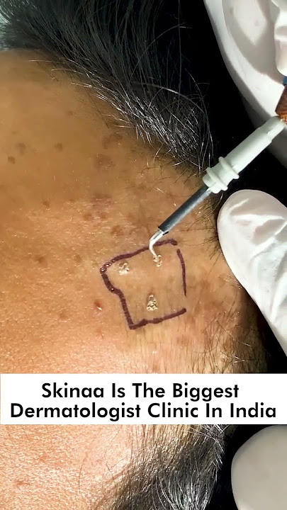 Do flat warts spread easily? #flat_wart #flat #wart #wartremoval #skinaaskincare #viral