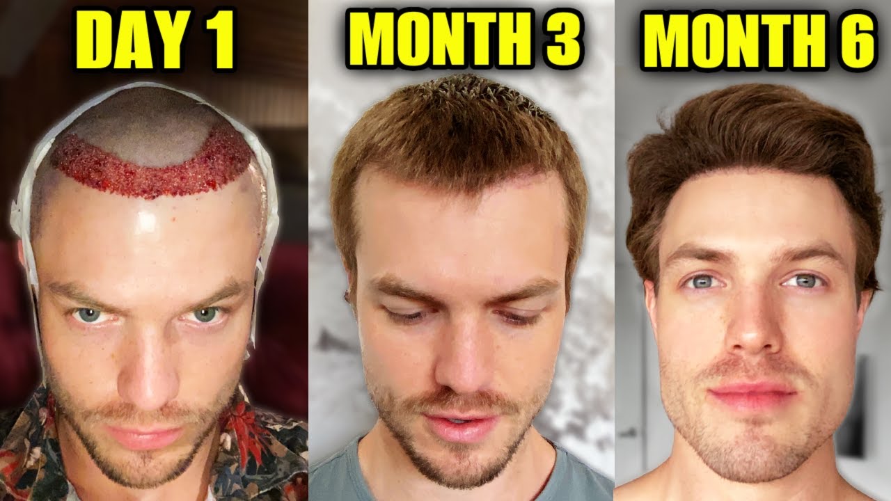 Power of Possibilities Brett Mavericks Hair Transplant