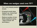 Basics of Breast Cancer Radiotherapy Treatment Planning