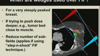 Basics of Breast Cancer Radiotherapy Treatment Planning