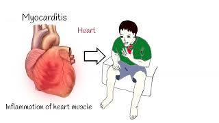 Myocarditis Associated with COVID 19 - Symptoms and Treatment