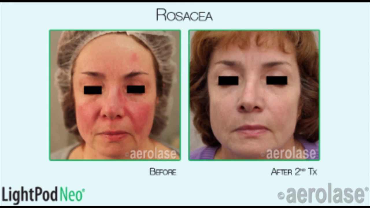 Rosacea & Redness Treatment with Aerolase Laser YouTube