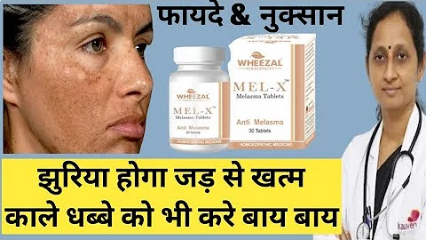 MEL - X Melasma Tablet  & Cream Review Hindi | सभी प्रकार की झाइयों जड़ से खत्म के लिए