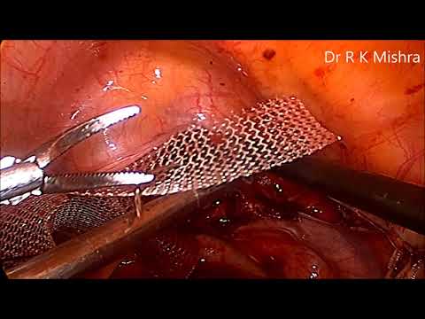 Total Laparoscopic Hysterectomy With Sacrocolpopexy