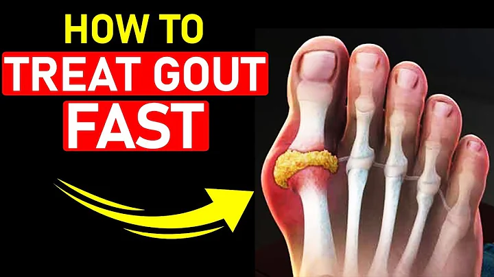 🔥Top 7 Gout Foot & Big Toe HOME Treatments [+1 BIG SECRET] - DayDayNews