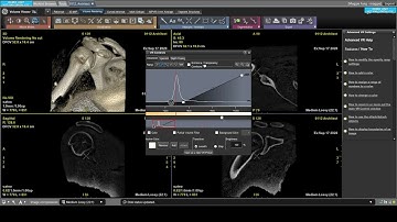 oZTEo MR Bone Imaging | Tutorial: How to perform 3D realistic volume illumination