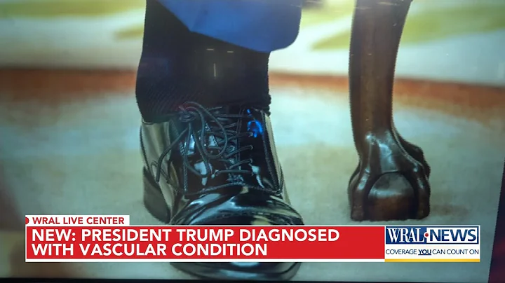 Trump diagnosed with chronic venous insufficiency following leg swelling