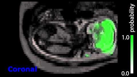 Fast Fully Automatic Brain Detection in Fetal MRI