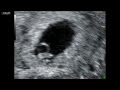 Echographie -- L'Embryon De 5 A 9 Semaines