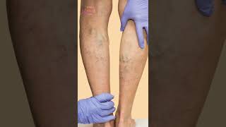 Can Varicose veins increase during pregnancy| Dr Kaurabhi Zade - Vascular and Oncology Clinic