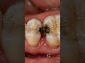 “Hidden Decay Between Teeth” – Interproximal cavity spreading inward