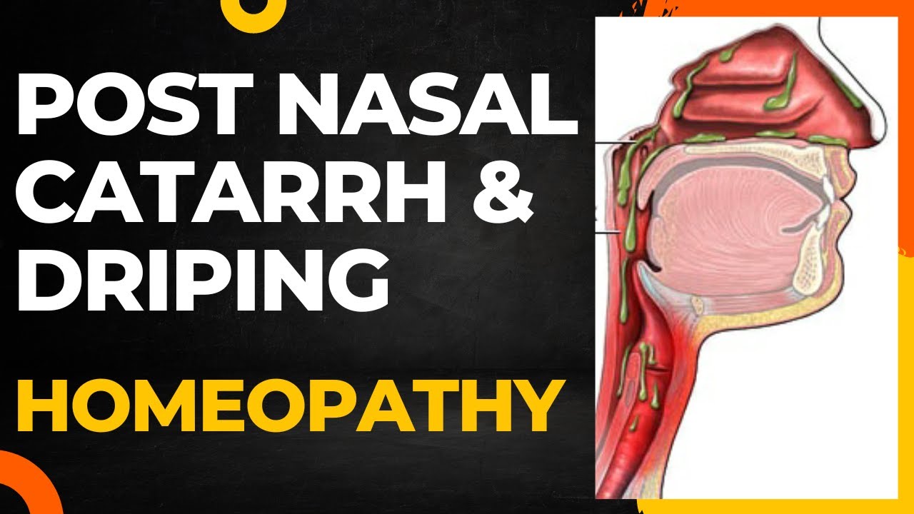 post nasal catarrh and homeopathic treatment || post nasal driping and post nasal droping !