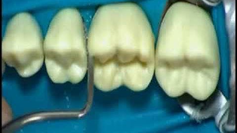 Amalgam Preparation class II