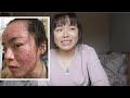 How a Doctor Healed Her Acne | Clear Skin Journey Story