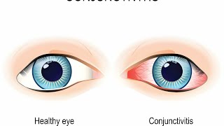 التهاب الرمد الربيعي للعين بسبب حبوب اللقاح SPRING CONJUNCTIVITIS