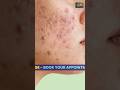 ✨Acne Treatment at Yours Clinic 🌿#acnetreatment #homeopathy #acnefree #clearskin #skinhealth