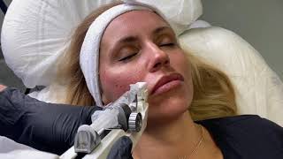 Video Protocol - Collagenbooster Jalupro Hmw