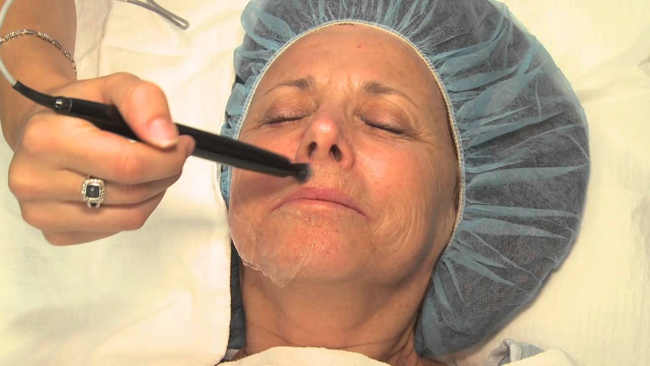 Thermi Tight and Thermi Rf  - Dr Nathan Newman Performs Procedures for Marcia