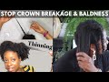 My HAIR LOSS Story and How to Prevent CCCA|  Week 5 PREVENT HAIR LOSS Challenge