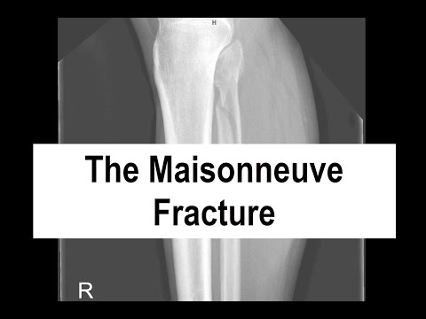 The Maisonneuve Fracture