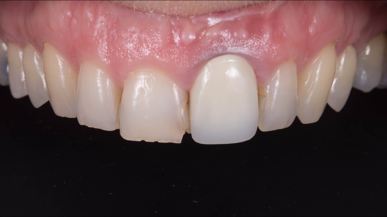21 CAF & CTG with one vertical incision - YouTube