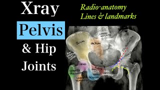 X-ray Pelvis & B/L hip l Anatomyl Viewsl Linesl Landmarksl Measurementsl Adult & Pediatric hip
