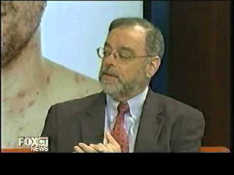 Video: Complications After Chickenpox In Adult Women And Men: Consequences