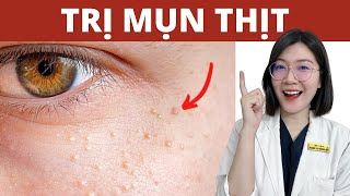 Cách Trị Mụn Thịt Trị Mụn Tại Nhà Thạc Sĩ - Bác Sĩ Phương Quý