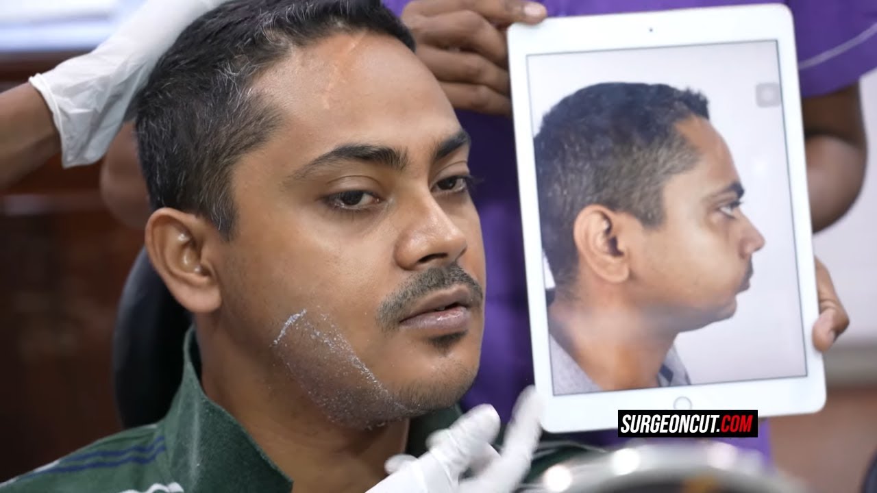 Chin Augmentation- Genioplasty/Jaw Sculpting - Complete Experience and best Results