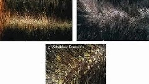 Get Rid of dandruff in 1 Day! _ Instant Dandruff Remedy at Home