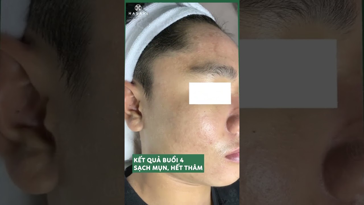 4 buổi dứt điểm tình trạng mụn 