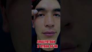 Икки кўзда туғма птоз: жарроҳлик амалиётидан сўнгги натижа