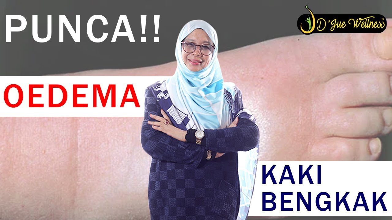 Dr jue - punca kaki anda bengkak (oedema) ini pekara yang perlu anda tahu!