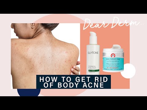 How to Get Rid of Body Acne | Dear Derm | Well+Good