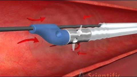 Thrombectomy Catheter - 3D Medical Animation
