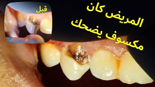 حشو تجميلي في الاسنان الامامية | طريقة حشو الاسنان وعلاج تسوس الاسنان | تجميل الأسنان والابتسامة
