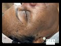 Dermatosis Papulosa Nigra a.k.a DPN Removal 
