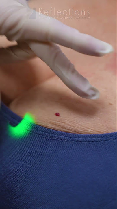 Bye-bye Cherry Angiomas! ✨🔴